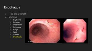 Esophagus
● ~ 25 cm of length
● Mucosa
○ Erythema
○ Erosions
○ Ulcerations
○ Strictures
○ Rings
○ Web
○ Varices
○ Diverticula
 