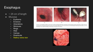 Esophagus
● ~ 25 cm of length
● Mucosa
○ Erythema
○ Erosions
○ Ulcerations
○ Strictures
○ Rings
○ Web
○ Varices
○ Diverticula
○ Mallory weiss tear
 