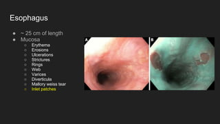 Esophagus
● ~ 25 cm of length
● Mucosa
○ Erythema
○ Erosions
○ Ulcerations
○ Strictures
○ Rings
○ Web
○ Varices
○ Diverticula
○ Mallory weiss tear
○ Inlet patches
 
