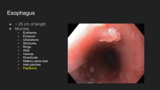 Esophagus
● ~ 25 cm of length
● Mucosa
○ Erythema
○ Erosions
○ Ulcerations
○ Strictures
○ Rings
○ Web
○ Varices
○ Diverticula
○ Mallory weiss tear
○ Inlet patches
○ Papilloma
 