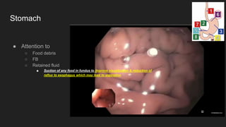 Stomach
● Attention to
○ Food debris
○ FB
○ Retained fluid
■ Suction of any food in fundus to improve visualization & reduction of
reflux to esophagus which may lead to aspiration
 