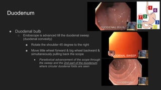 ● Duodenal bulb
○ Endoscope is advanced till the duodenal sweep
(duodenal convexity)
■ Rotate the shoulder 45 degree to the right
■ Move little wheel forward & big wheel backward &
simultaneously pulling back the scope
● Paradoxical advancement of the scope through
the sweep and the 2nd part of the duodenum
where circular duodenal folds are seen
Duodenum
DUODENAL SWEEP
 