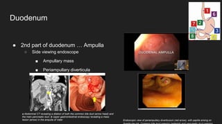 ● 2nd part of duodenum … Ampulla
○ Side viewing endoscope
■ Ampullary mass
■ Periampullary diverticula
Duodenum
Endoscopic view of periampullary diverticulum (red arrow), with papilla arising on
a Abdominal CT revealing a dilation of both the common bile duct (arrow head) and
the main pancreatic duct. b Upper gastrointestinal endoscopy revealing a mass
lesion (arrow) in the ampulla of Vater
 