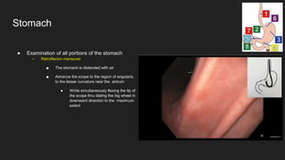 ● Examination of all portions of the stomach
○ Retroflexion maneuver
■ The stomach is distended with air
■ Advance the scope to the region of angularis,
to the lesser curvature near the antrum
● While simultaneously flexing the tip of
the scope thru dialing the big wheel in
downward direction to the maximum
extent
Stomach
 