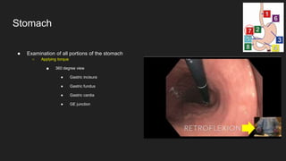 ● Examination of all portions of the stomach
○ Applying torque
■ 360 degree view
● Gastric incisura
● Gastric fundus
● Gastric cardia
● GE junction
Stomach
 