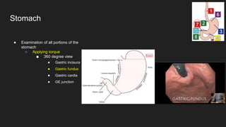 ● Examination of all portions of the
stomach
○ Applying torque
■ 360 degree view
● Gastric incisura
● Gastric fundus
● Gastric cardia
● GE junction
Stomach
 