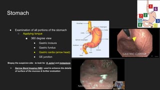 ● Examination of all portions of the stomach
○ Applying torque
■ 360 degree view
● Gastric incisura
● Gastric fundus
● Gastric cardia (arrow head)
● GE junction
Biopsy the suspicion site: to look for H. pylori and metaplasia
➢ Narrow Band Imaging (NBI): used to enhance the details
of surface of the mucosa & further evaluation
Stomach
 