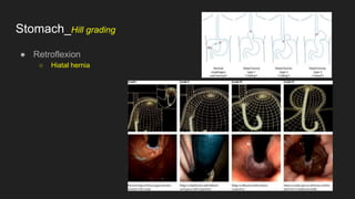 Stomach_Hill grading
● Retroflexion
○ Hiatal hernia
 