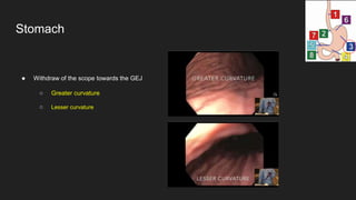 ● Withdraw of the scope towards the GEJ
○ Greater curvature
○ Lesser curvature
Stomach
 