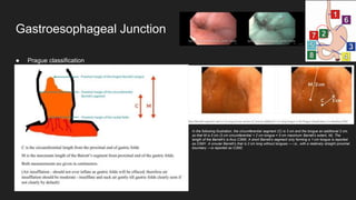 ● Prague classification
Gastroesophageal Junction
In the following illustration, the circumferential segment (C) is 3 cm and the tongue an additional 2 cm,
so that M is 5 cm (3 cm circumferential + 2 cm tongue = 5 cm maximum Barrett’s extent, M). The
length of the Barrett’s is thus C3M5. A short Barrett’s segment only forming a 1-cm tongue is reported
as C0M1. A circular Barrett’s that is 2 cm long without tongues — i.e., with a relatively straight proximal
boundary —is reported as C2M2.
 