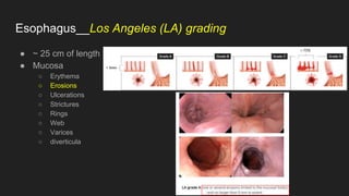 Esophagus__Los Angeles (LA) grading
● ~ 25 cm of length
● Mucosa
○ Erythema
○ Erosions
○ Ulcerations
○ Strictures
○ Rings
○ Web
○ Varices
○ diverticula
 