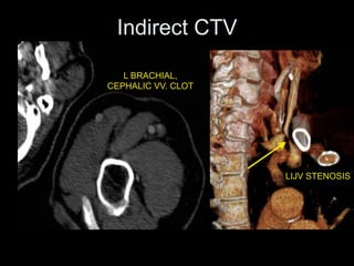 L BRACHIAL,
CEPHALIC VV. CLOT
LIJV STENOSIS
Indirect CTV
 