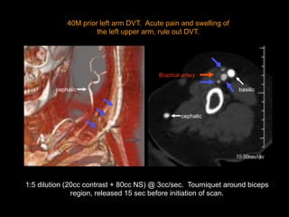 40M prior left arm DVT. Acute pain and swelling of
the left upper arm, rule out DVT.
1:5 dilution (20cc contrast + 80cc NS) @ 3cc/sec. Tourniquet around biceps
region, released 15 sec before initiation of scan.
basilic
Brachial artery
basilic
cephalic
cephalic
 