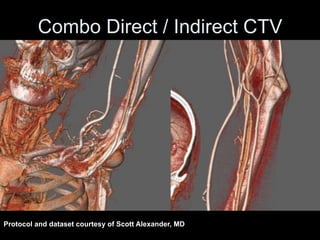 Combo Direct / Indirect CTV
Protocol and dataset courtesy of Scott Alexander, MD
 