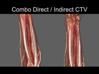 Combo Direct / Indirect CTV
 