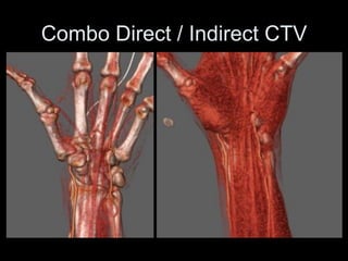 Combo Direct / Indirect CTV
 