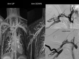 Arm UP Arm DOWN
 