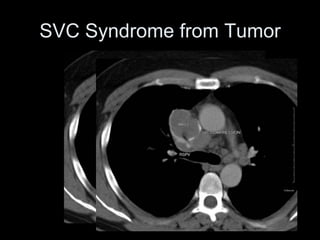 SVC Syndrome from Tumor
 