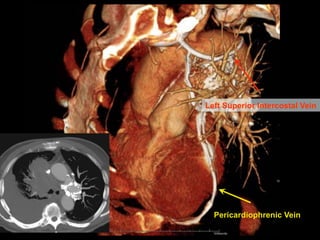 Left Superior Intercostal Vein
Pericardiophrenic Vein
 