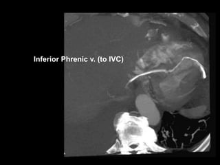 Inferior Phrenic v. (to IVC)
 