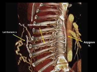 Lat thoracic v.
Intercostal veins
Azygous
v.
 