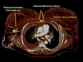 Internal Mammary Veins
Thoraco-acromio-
Clavicular vv.
Areolar Venous Plexus
 