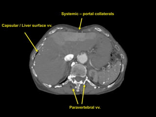 Paravertebral vv.
Capsular / Liver surface vv.
Systemic – portal collaterals
 