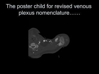 The poster child for revised venous
plexus nomenclature……
 