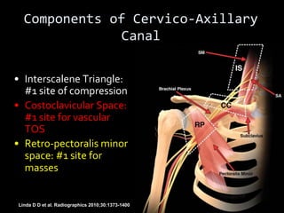 Linda D D et al. Radiographics 2010;30:1373-1400
Components of Cervico-Axillary
Canal
• Interscalene Triangle:
#1 site of compression
• Costoclavicular Space:
#1 site for vascular
TOS
• Retro-pectoralis minor
space: #1 site for
masses
 