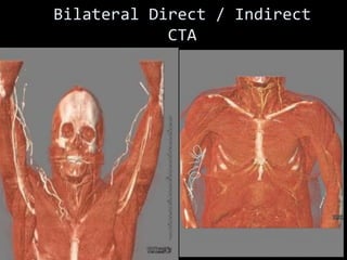 Bilateral Direct / Indirect
CTA
 