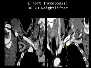 Effort Thrombosis:
36 YO weightlifter
 