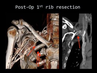Post-Op 1st rib resection
 