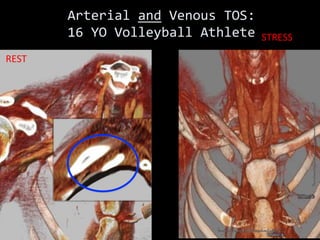 Arterial and Venous TOS:
16 YO Volleyball Athlete
REST
STRESS
 
