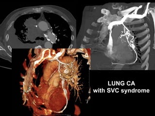 LUNG CA
with SVC syndrome
 