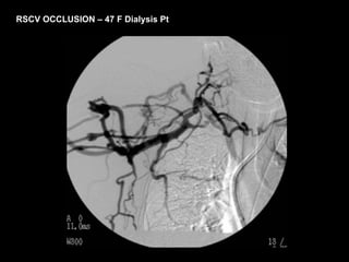 RSCV OCCLUSION – 47 F Dialysis Pt
 