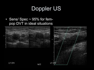Doppler US
• Sens/ Spec ~ 95% for fem-
pop DVT in ideal situations
 