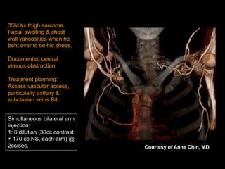 35M hx thigh sarcoma.
Facial swelling & chest
wall varicosities when he
bent over to tie his shoes.
Documented central
venous obstruction.
Treatment planning:
Assess vascular access,
particularly axillary &
subclavian veins B/L.
Simultaneous bilateral arm
injection:
1: 6 dilution (30cc contrast
+ 170 cc NS, each arm) @
2cc/sec. Courtesy of Anne Chin, MD
 
