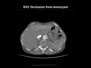 SVC Occlusion from Aneurysm
 