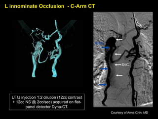 LT IJ injection 1:2 dilution (12cc contrast
+ 12cc NS @ 2cc/sec) acquired on flat-
panel detector Dyna-CT.
SVC
RIMV
L innominate Occlusion - C-Arm CT
Courtesy of Anne Chin, MD
 