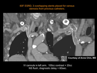 IV cannula in left arm. 100cc contrast + 20cc
NS flush, diagnostic delay = 60sec.
60F ESRD, 3 overlapping stents placed for venous
stenosis from previous catheters.
Courtesy of Anne Chin, MD
 
