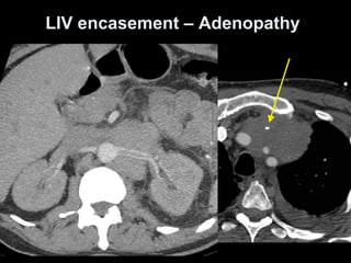 LIV encasement – Adenopathy
 