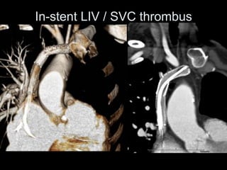 In-stent LIV / SVC thrombus
 