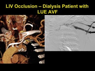 LIV Occlusion – Dialysis Patient with
LUE AVF
 
