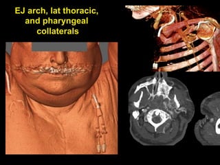 EJ arch, lat thoracic,
and pharyngeal
collaterals
 