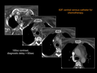 100cc contrast,
diagnostic delay = 60sec
62F central venous catheter for
chemotherapy.
 