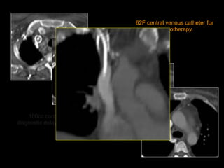 100cc contrast,
diagnostic delay = 60sec
62F central venous catheter for
chemotherapy.
 