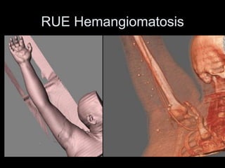 RUE Hemangiomatosis
 