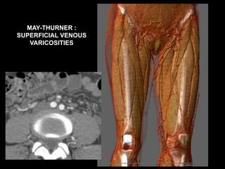 MAY-THURNER :
SUPERFICIAL VENOUS
VARICOSITIES
 