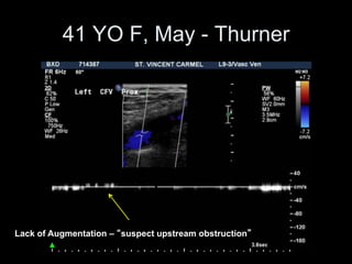 41 YO F, May - Thurner
Lack of Augmentation – suspect upstream obstruction
 