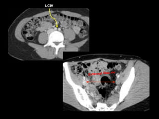 LCIV
External iliac vv.
 